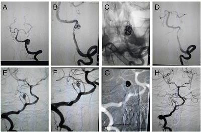 Clinical Efficacy and Quality of Life Follow-Up of Reconstructive Endovascular Therapy for Acute Intracranial Vertebral Artery Dissection Aneurysms